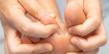 Athlete's foot