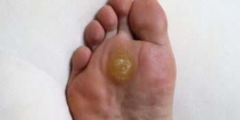 Foot Calluses