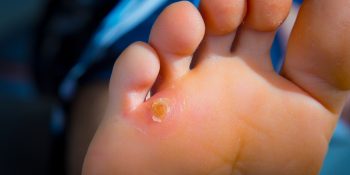 Corns On Feet