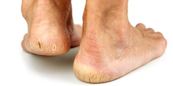 Dry Skin on Feet and Cracked Heels