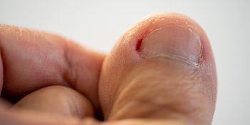 Ingrown Toenail